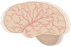 Wat is een hersenbloeding